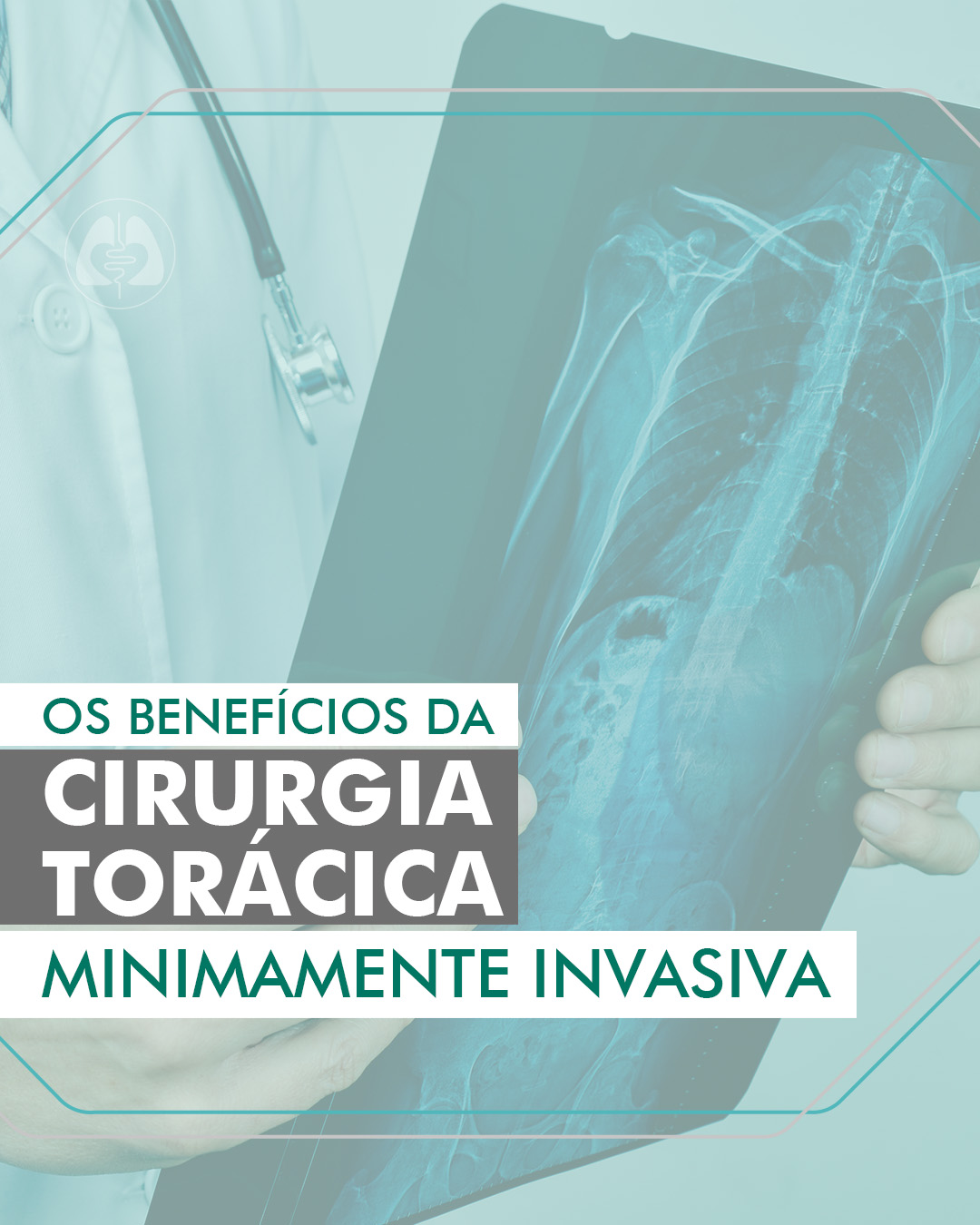 Cirurgia torácica minimamente invasiva