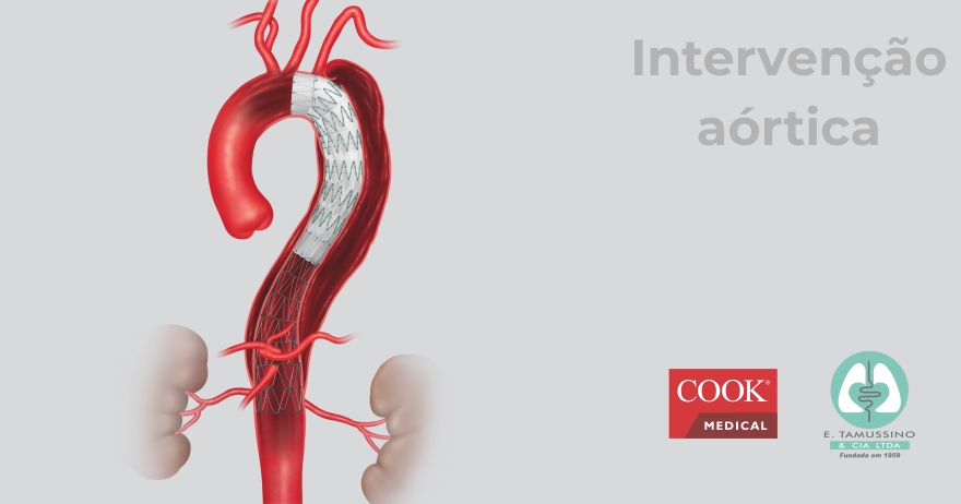 Estudo clínico STABLE II sobre tratamento endovascular de dissecção aórtica tipo B aguda e complicada com dispositivo composto Zenith Dissection