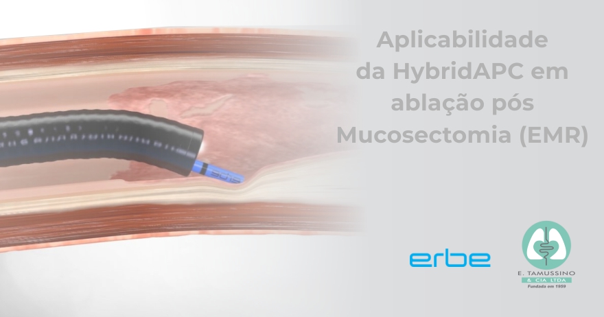 Mucosectomia (EMR) para tumores de espalhamento lateral (LST) com ablação da margem utilizando a HybridAPC