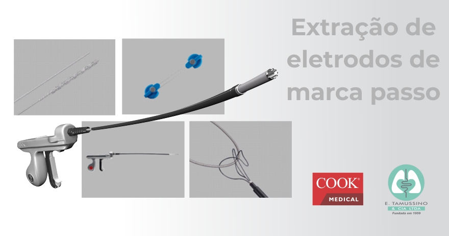 Sucesso na remoção percutânea de  cabos-eletrodos endocárdicos implantados há 18 anos utilizando ferramentas de extração.