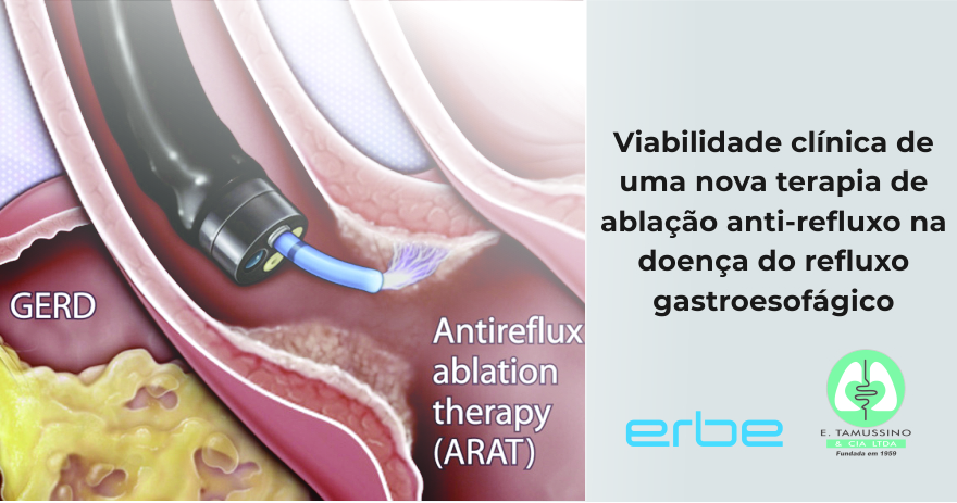 Viabilidade clínica de uma nova terapia de ablação anti-refluxo na doença do refluxo gastroesofágico