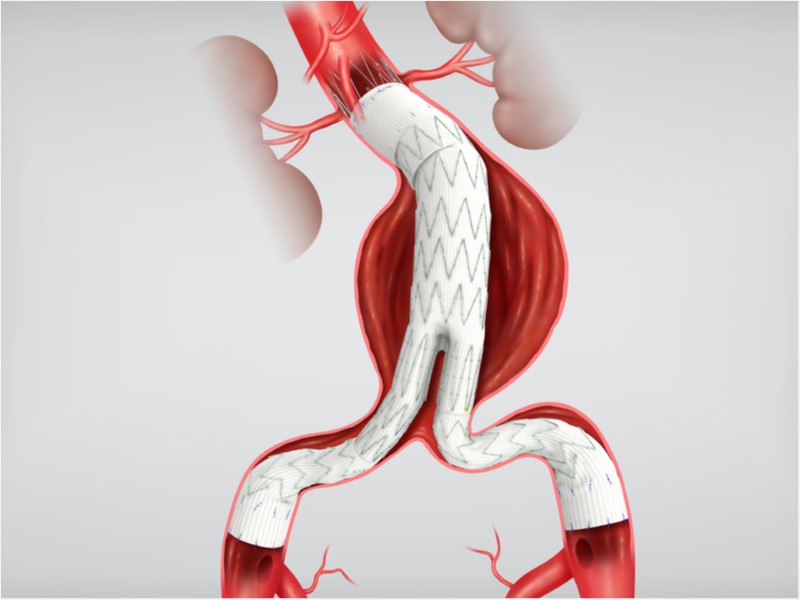 Enxerto Endovascular Abdominal Zenith® Flex®