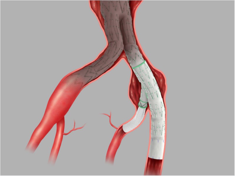 Endoprótese Endovascular Ramificada de Ilíaca Zenith® Branch