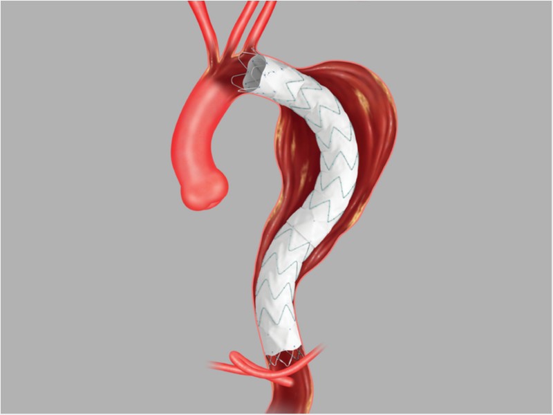 Endoprótese Endovascular Zenith Alpha™ Torácico